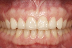 Изцяло керамични корони - e.max