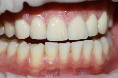 Циркониеви корони